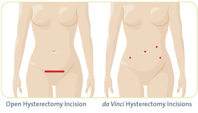 Davinci Robotic Hysterectomy 